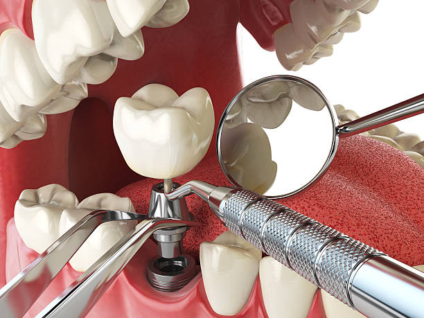 Best Knocked-Out Tooth (Avulsed Tooth) Treatment in Cashton, WI